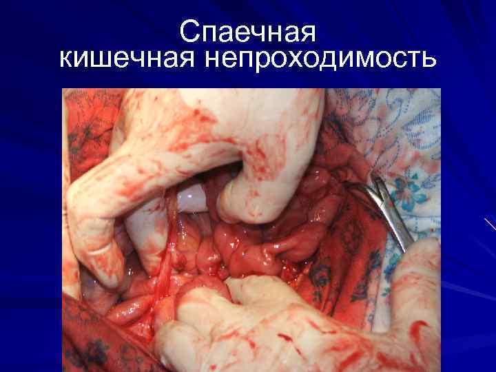 Спаечная кишечная непроходимость 