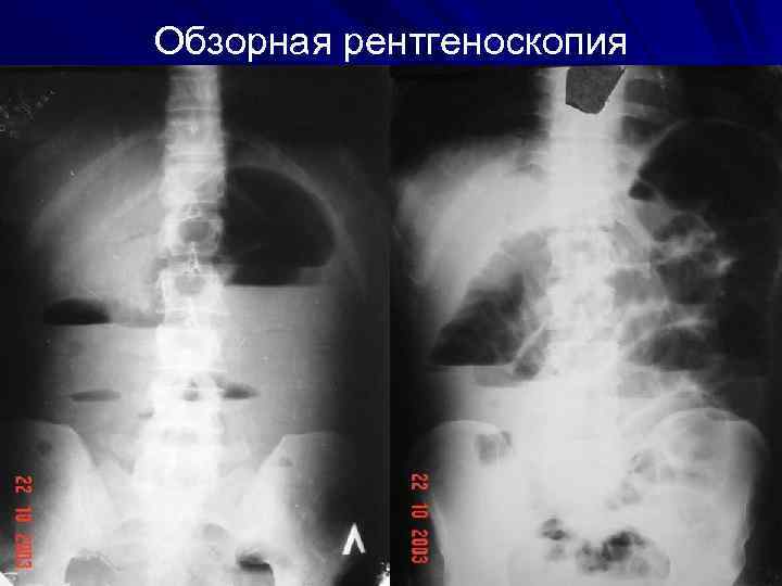 Обзорная рентгеноскопия 