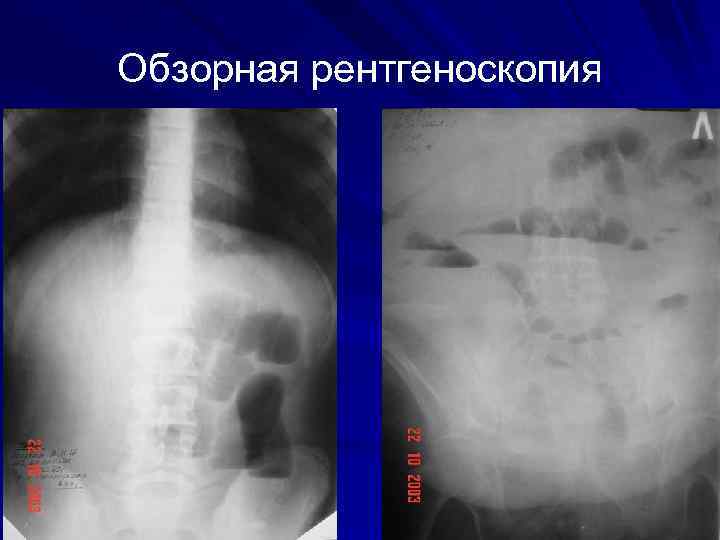 Обзорная рентгеноскопия 