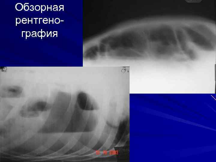 Обзорная рентгенография 