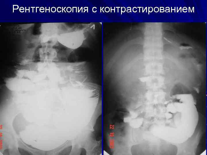 Рентгеноскопия с контрастированием 
