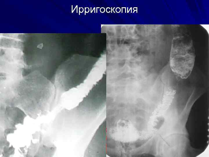 Ирригоскопия 