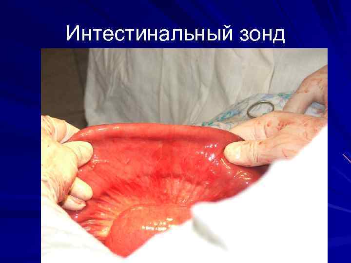 Интестинальный зонд 