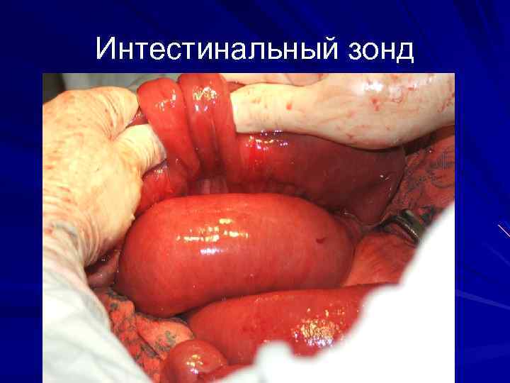 Интестинальный зонд 