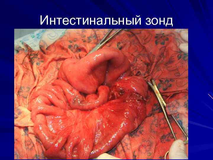 Интестинальный зонд 