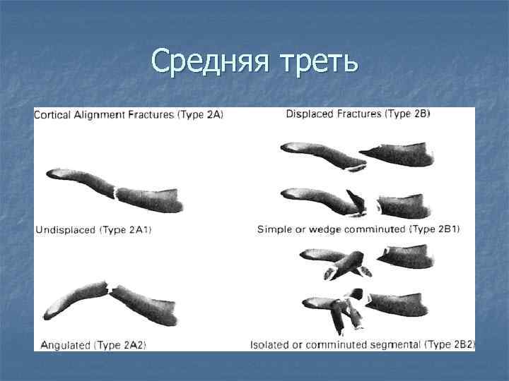 Средняя треть 