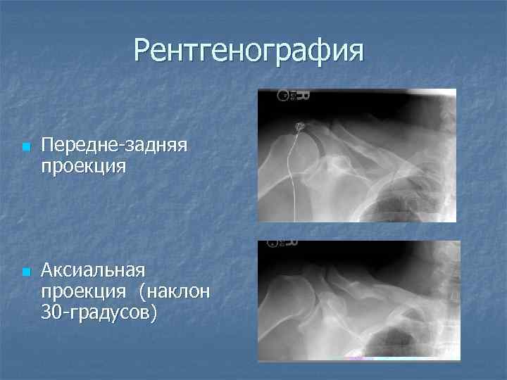 Рентгенография n n Передне-задняя проекция Аксиальная проекция (наклон 30 -градусов) 