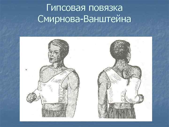 Гипсовая повязка Смирнова-Ванштейна 