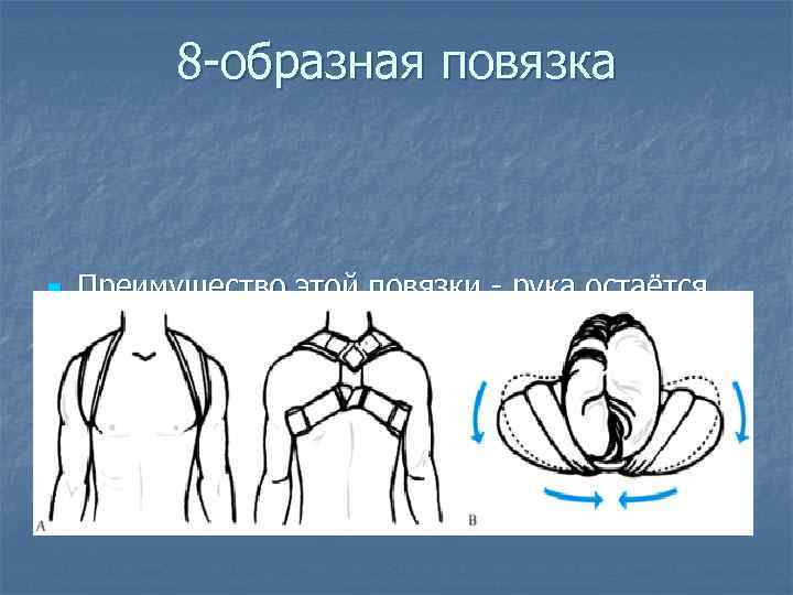 8 -образная повязка n Преимущество этой повязки - рука остаётся свободной и может использоваться