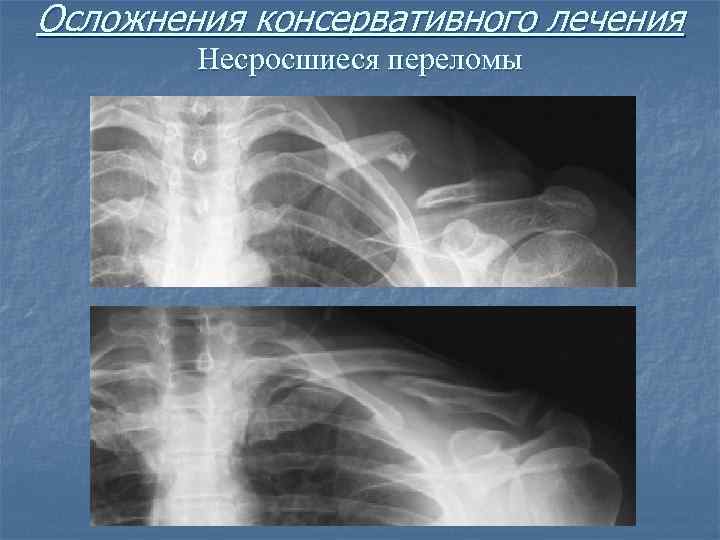 Осложнения консервативного лечения Несросшиеся переломы 