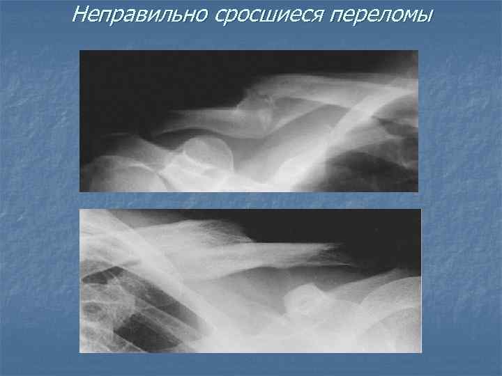 Неправильно сросшиеся переломы 