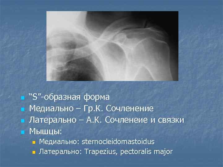 n n “S”-образная форма Медиально – Гр. К. Сочленение Латерально – А. К. Сочленеие