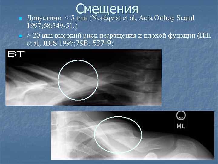 n n Смещения Допустимо < 5 mm (Nordqvist et al, Acta Orthop Scand 1997;