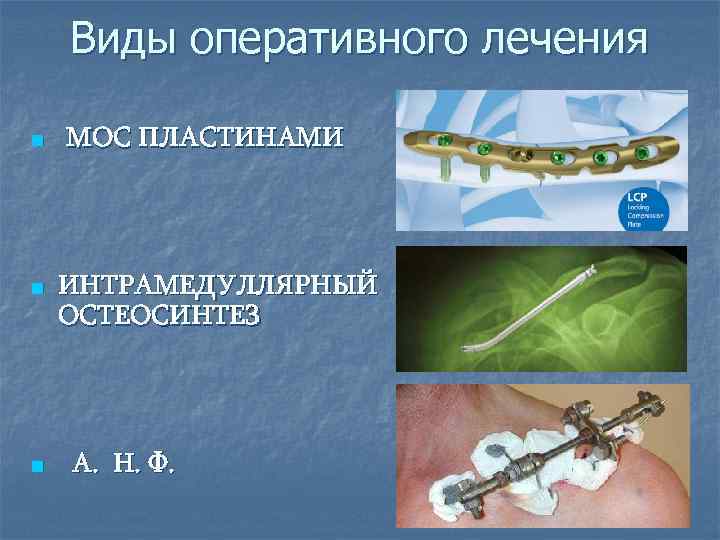 Виды оперативного лечения n n n МОС ПЛАСТИНАМИ ИНТРАМЕДУЛЛЯРНЫЙ ОСТЕОСИНТЕЗ А. Н. Ф. 