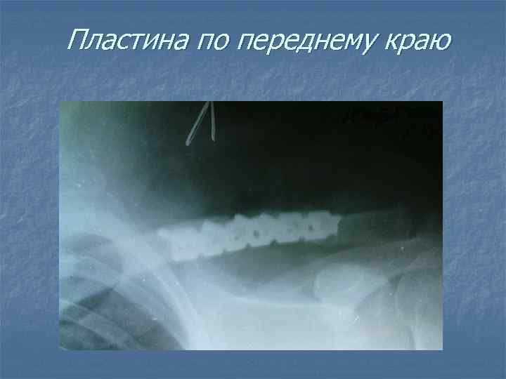 Пластина по переднему краю 