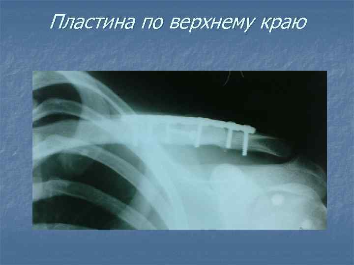 Пластина по верхнему краю 