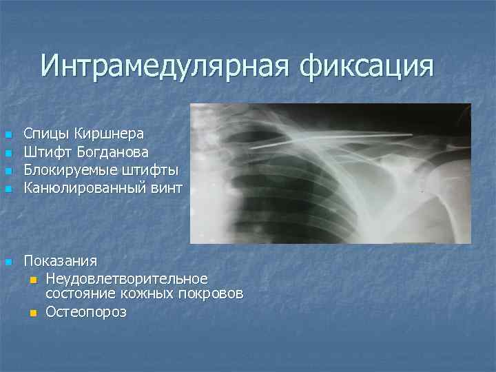 Интрамедулярная фиксация n n n Спицы Киршнера Штифт Богданова Блокируемые штифты Канюлированный винт Показания