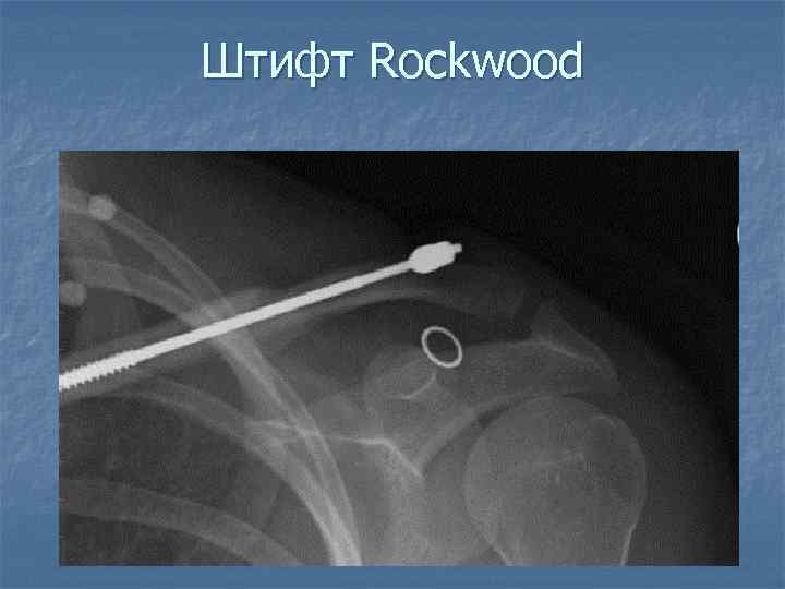 Штифт Rockwood 