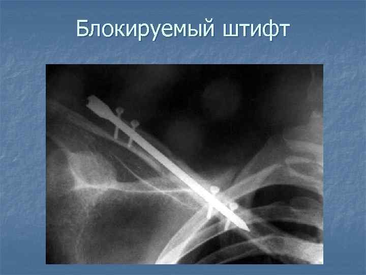 Блокируемый штифт 