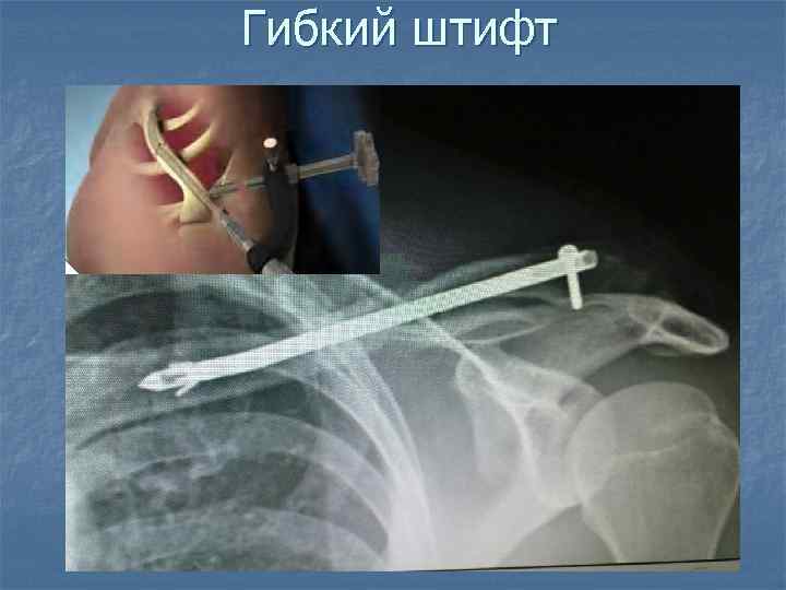 Гибкий штифт 