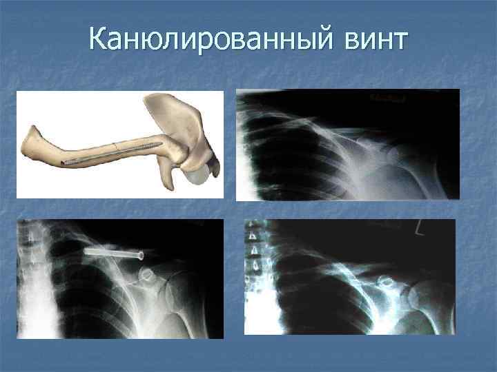 Канюлированный винт 