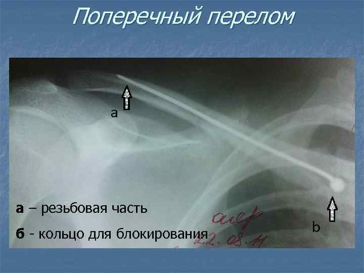 Поперечный перелом а – резьбовая часть б - кольцо для блокирования 