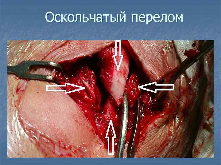 Оскольчатый перелом 