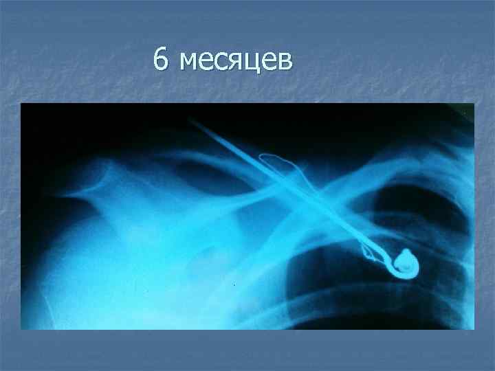 6 месяцев 