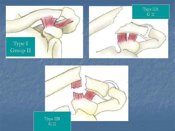 Type IIA G II Type I Group II Type IIB G II 