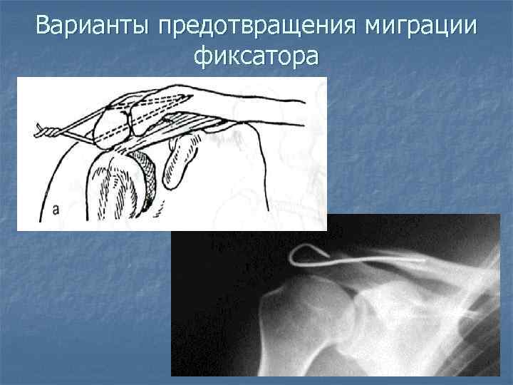 Варианты предотвращения миграции фиксатора 