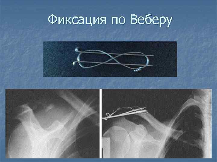 Фиксация по Веберу 