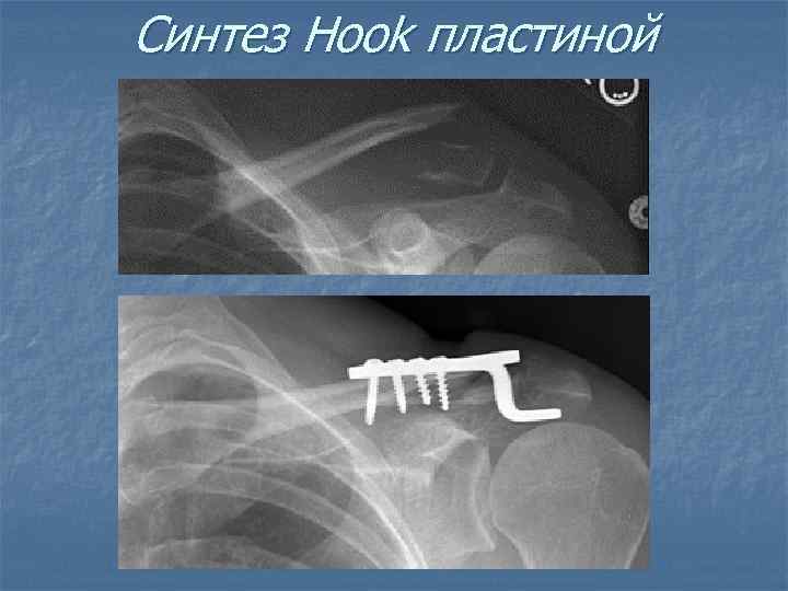 Синтез Hook пластиной 