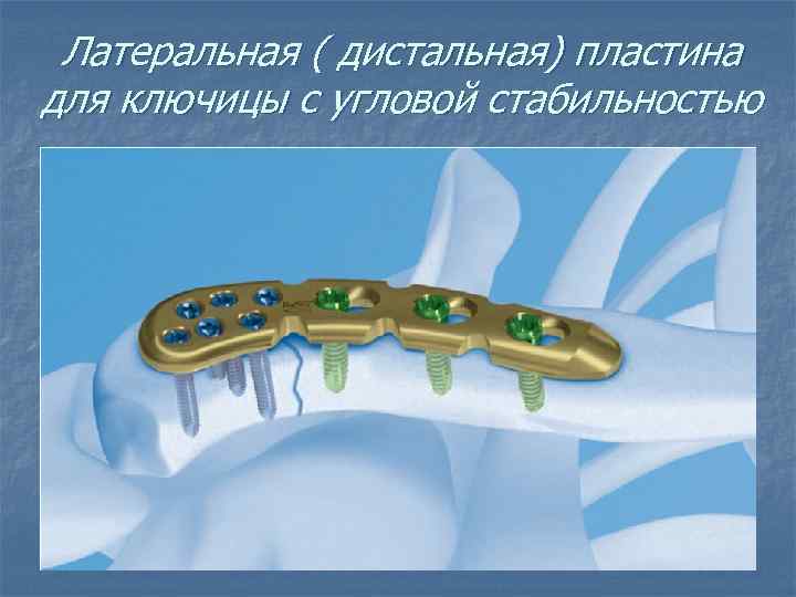 Латеральная ( дистальная) пластина для ключицы с угловой стабильностью 