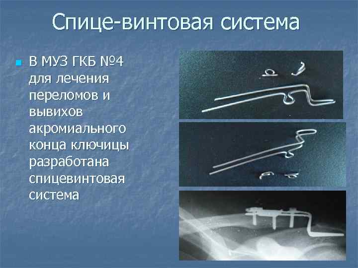 Спице-винтовая система n В МУЗ ГКБ № 4 для лечения переломов и вывихов акромиального