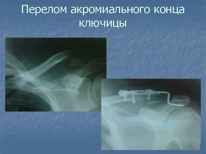 Перелом акромиального конца ключицы 