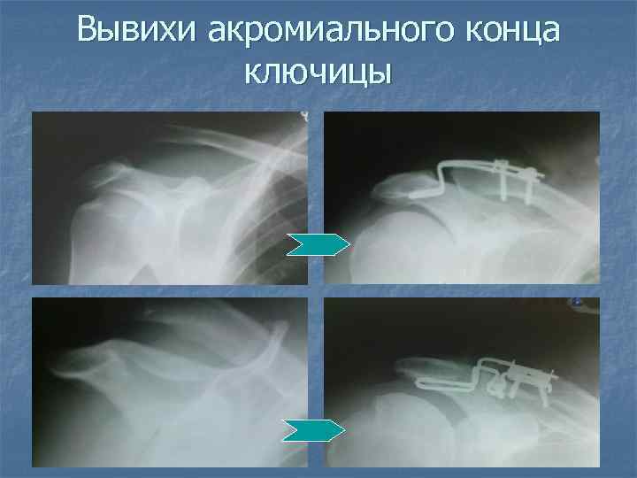 Вывихи акромиального конца ключицы 