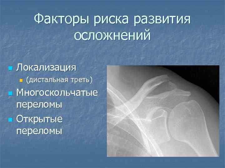 Факторы риска развития осложнений n Локализация n n n (дистальная треть) Многоскольчатые переломы Открытые