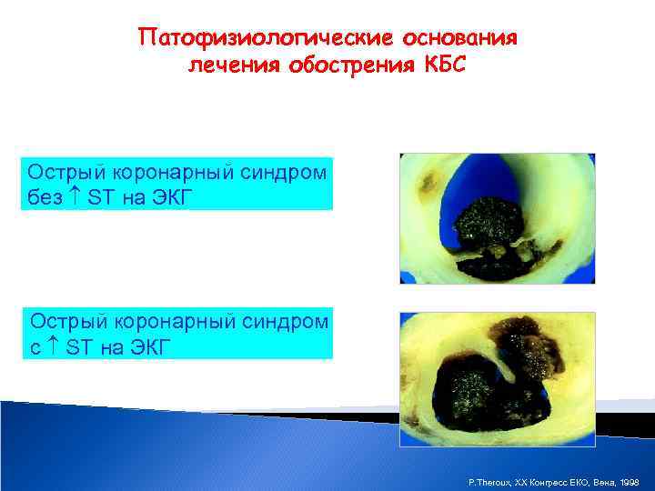 Патофизиологические основания лечения обострения КБС Острый коронарный синдром без ST на ЭКГ Острый коронарный