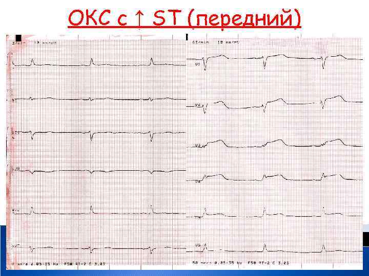 ОКС с ↑ ST (передний) 