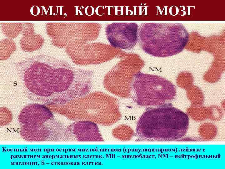 Картина крови при миелобластном лейкозе остром