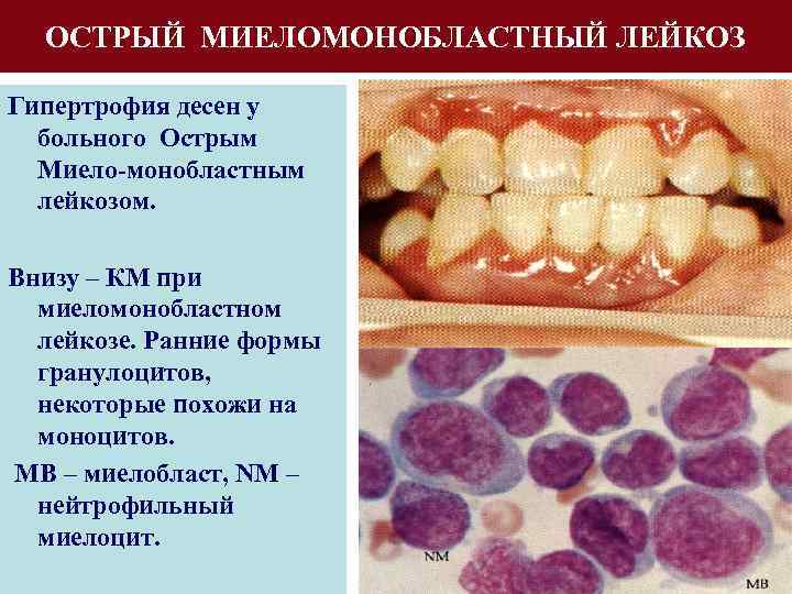 Острый недифференцированный лейкоз картина крови