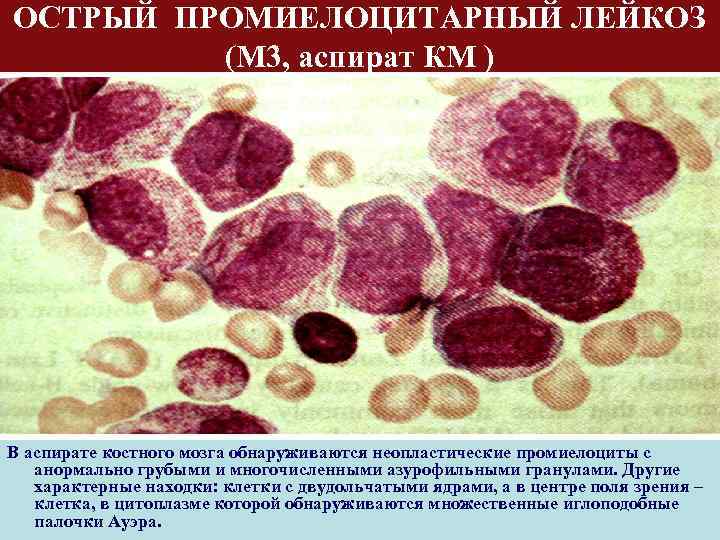 ОСТРЫЙ ПРОМИЕЛОЦИТАРНЫЙ ЛЕЙКОЗ (М 3, аспират КМ ) В аспирате костного мозга обнаруживаются неопластические
