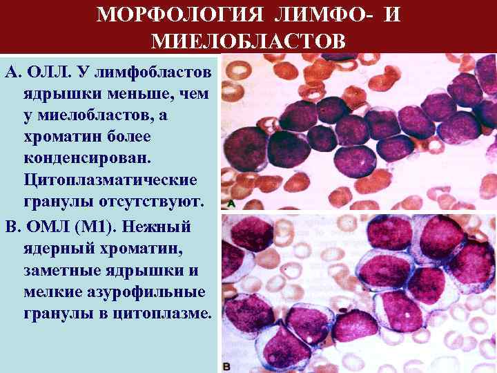 МОРФОЛОГИЯ ЛИМФО- И МИЕЛОБЛАСТОВ А. ОЛЛ. У лимфобластов ядрышки меньше, чем у миелобластов, а