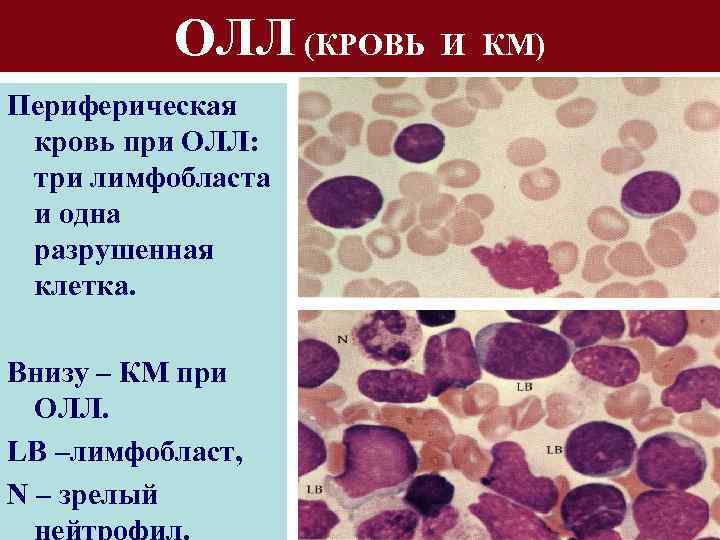 ОЛЛ (КРОВЬ И КМ) Периферическая кровь при ОЛЛ: три лимфобласта и одна разрушенная клетка.