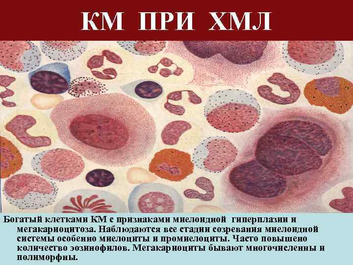 Моноцитарный лейкоз картина крови