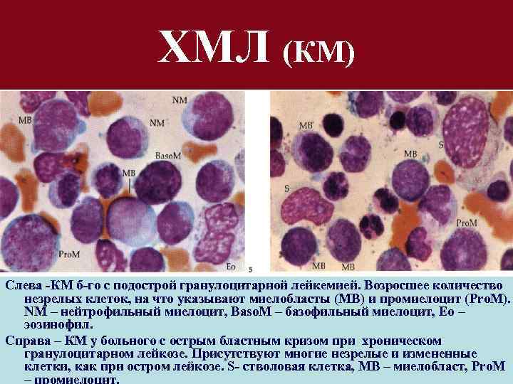 ХМЛ (КМ) Слева -КМ б-го с подострой гранулоцитарной лейкемией. Возросшее количество незрелых клеток, на