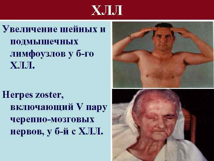 ХЛЛ Увеличение шейных и подмышечных лимфоузлов у б-го ХЛЛ. Herpes zoster, включающий V пару
