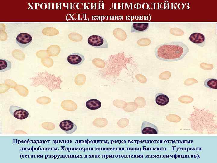 ХРОНИЧЕСКИЙ ЛИМФОЛЕЙКОЗ (ХЛЛ, картина крови) Преобладают зрелые лимфоциты, редко встречаются отдельные лимфобласты. Характерно множество