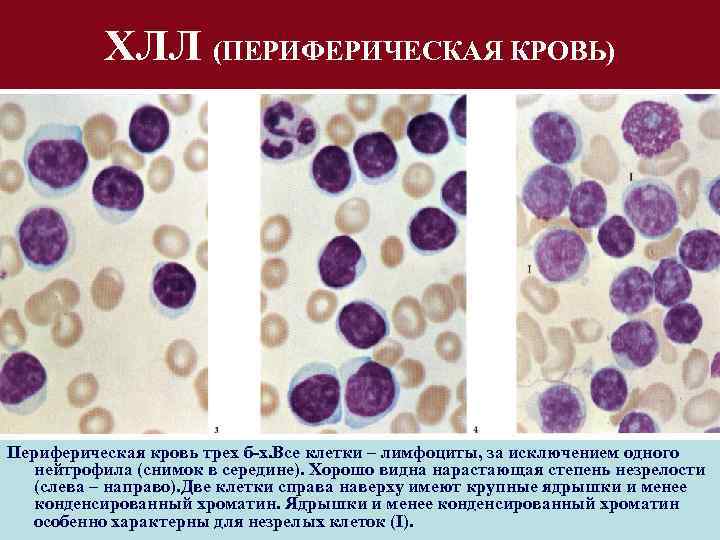 ХЛЛ (ПЕРИФЕРИЧЕСКАЯ КРОВЬ) Периферическая кровь трех б-х. Все клетки – лимфоциты, за исключением одного