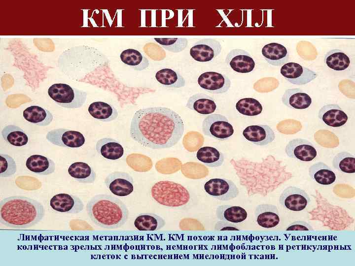 КМ ПРИ ХЛЛ Лимфатическая метаплазия КМ. КМ похож на лимфоузел. Увеличение количества зрелых лимфоцитов,